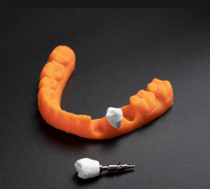 Nanocellulose-based dental implant crown created in VTT lab.